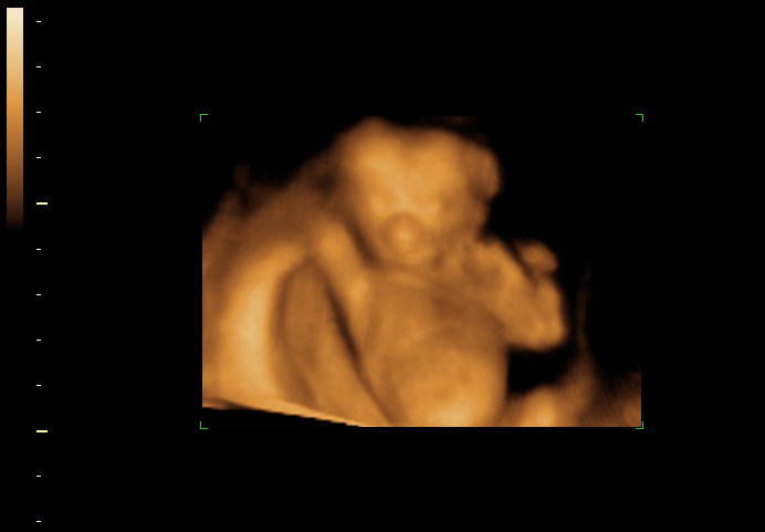 3D ultrasound image at 16 weeks